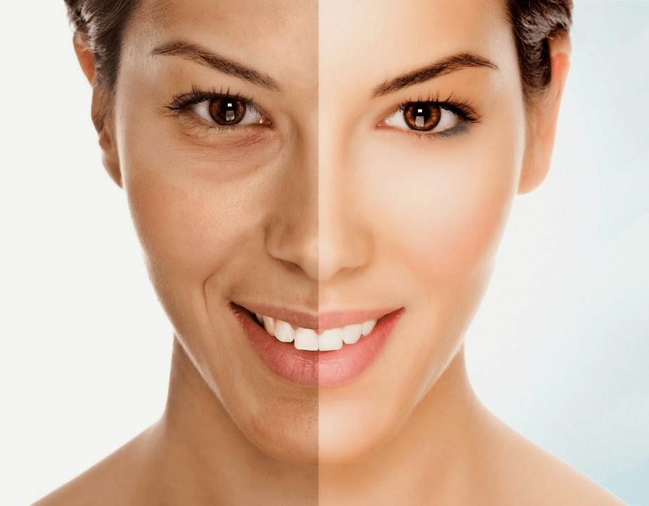 Intenskin facial rejuvenation