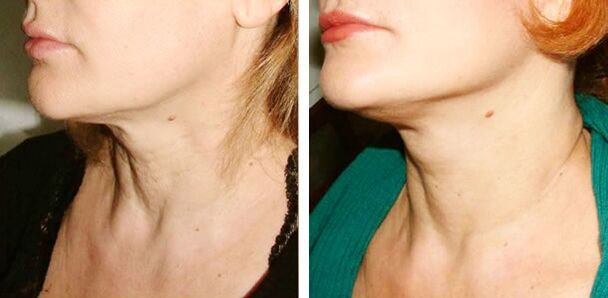 Before and after laser rejuvenation photos 1