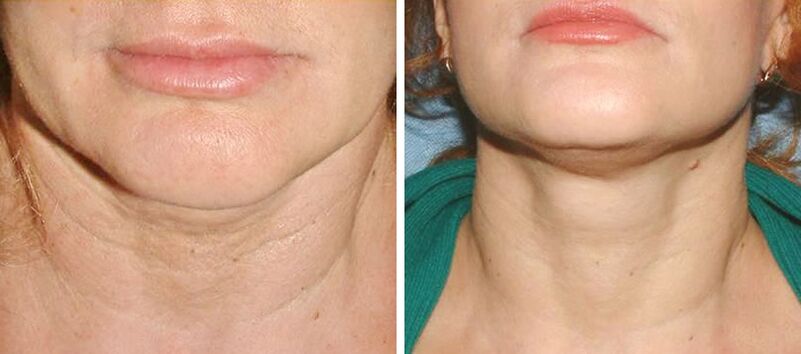 Before and after laser rejuvenation photos 2