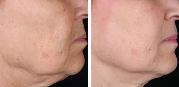 Before and after laser rejuvenation photos 3