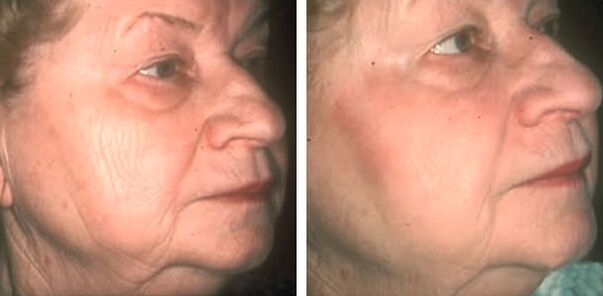 Before and after laser rejuvenation photos 4