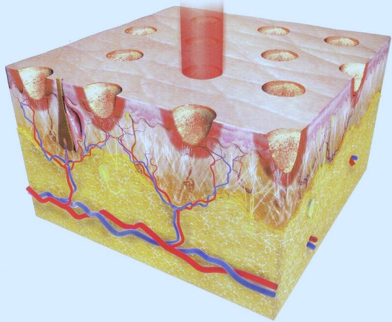 Fractional laser pyrolysis