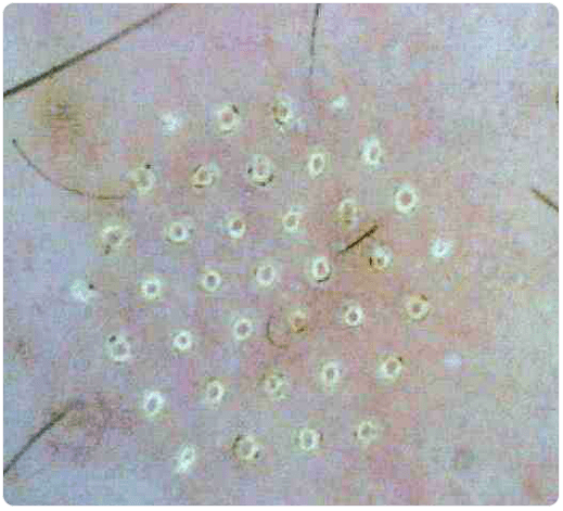 Skin under microscope after partial rejuvenation