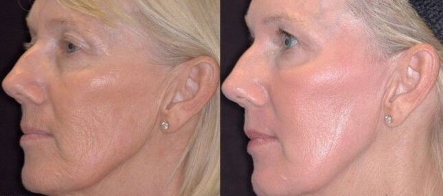 Before and After Topical Rejuvenation Photos 3