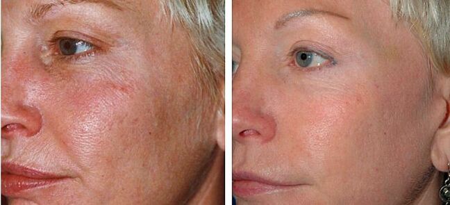 Before and after topical rejuvenation photos 4