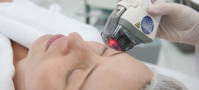 Fractional Laser Skin Resurfacing