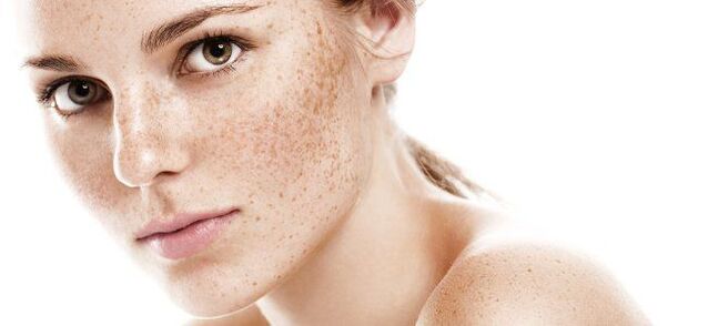 Freckles as an indicator of partial rejuvenation