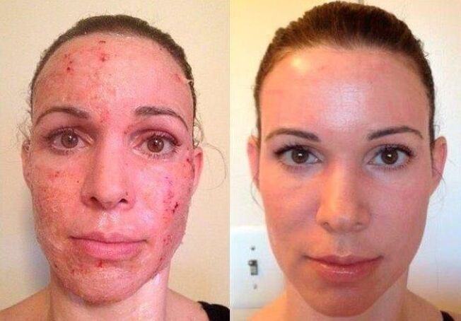 Partial skin rejuvenation before and after photos 1