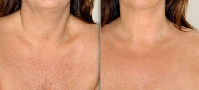 Partial skin rejuvenation before and after photos 2