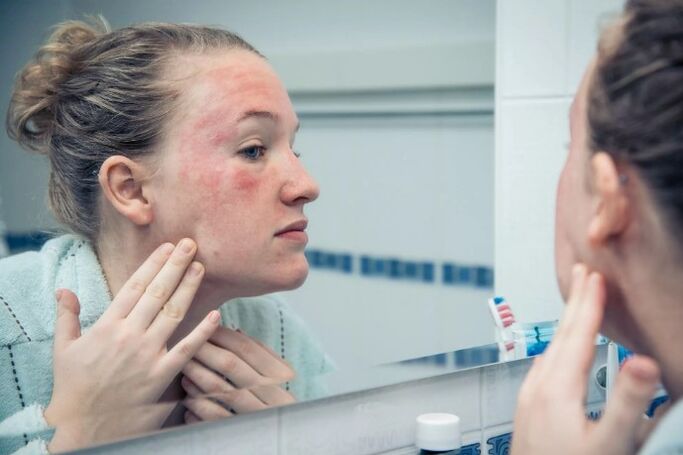 Chronic skin disease is in the aggravated stage