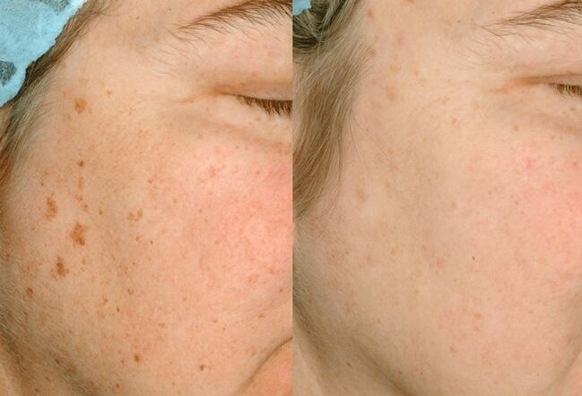 Remove pigmentation from the skin