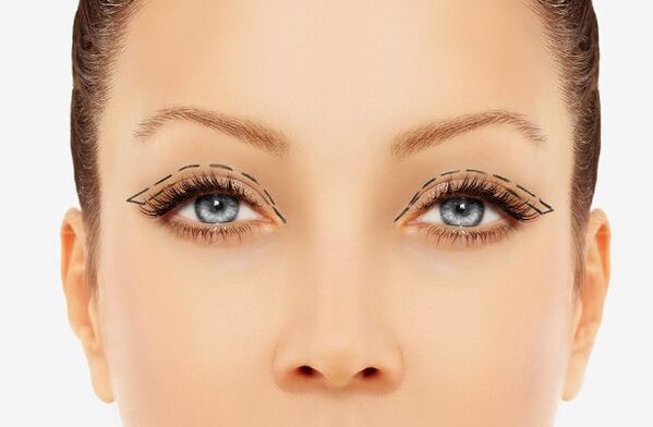 Eyelid profile